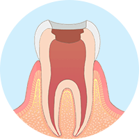 虫歯になった部分を器具を使って除去する。