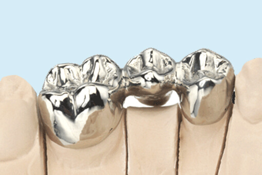 歯の残根治療または抜歯治療