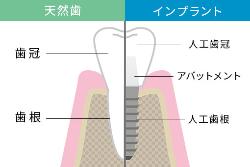 インプラントは第二の永久歯