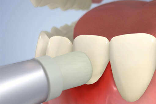歯肉縁上の歯石除去