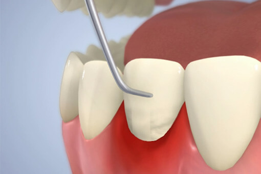 歯表面の歯石除去