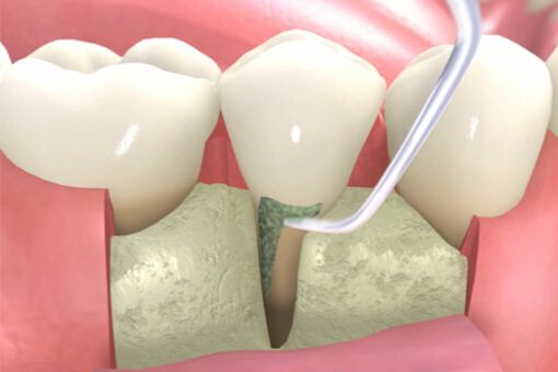 歯根の歯石除去