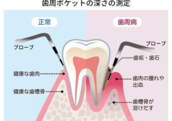 歯周ポケット検査