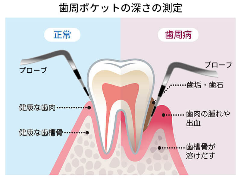 歯周ポケット検査
