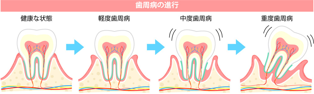 歯周病の進行