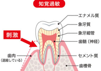 知覚過敏